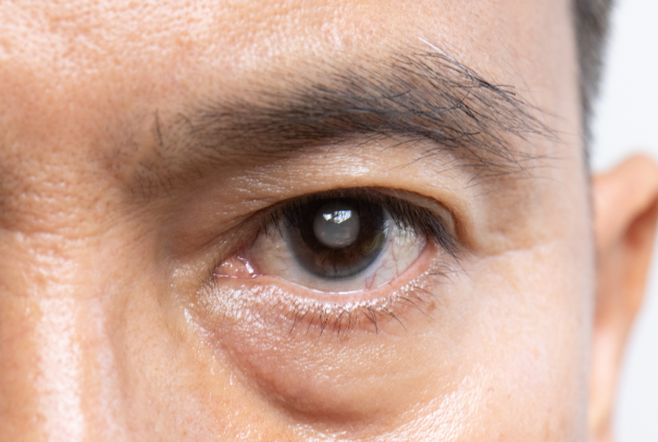 白内障は若い人でもなる可能性がある